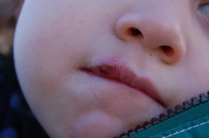 herpes labial en los labios del bebé