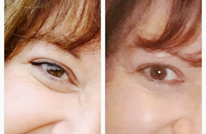 efectos de la vitamina e en las arrugas de los ojos